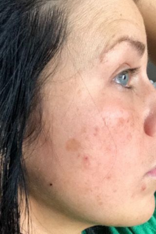 My post-acne marks are finally fading