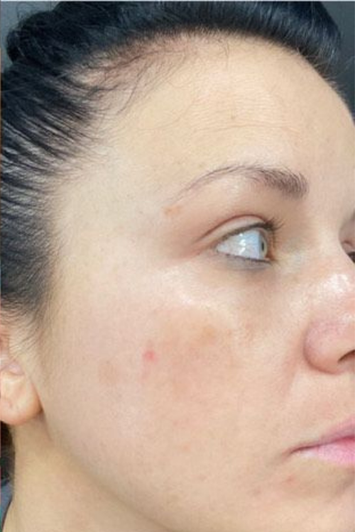 My post-acne marks are finally fading