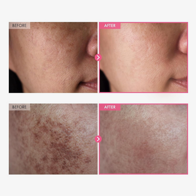 Arbutin 7% & Tranexamic Acid 4% Brightening Cream